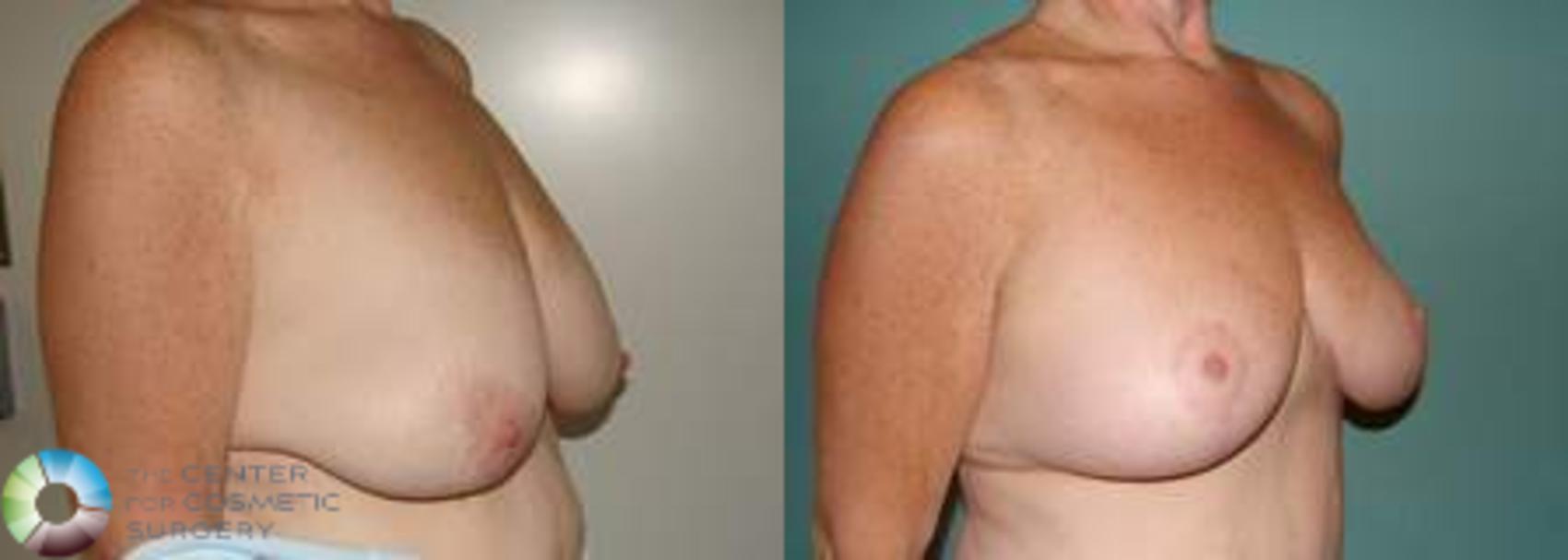 Before & After Breast Lift Case 542 View #2 View in Golden, CO
