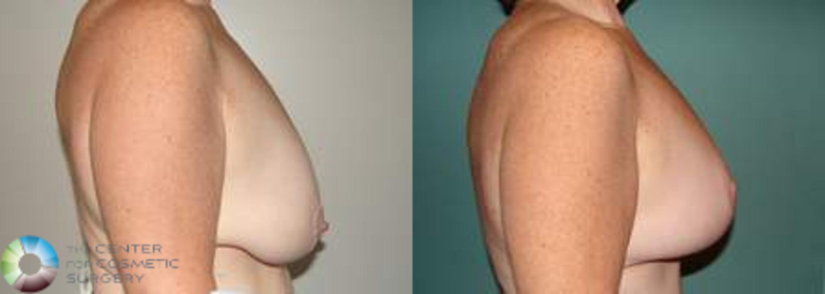 Before & After Breast Lift Case 542 View #3 View in Golden, CO