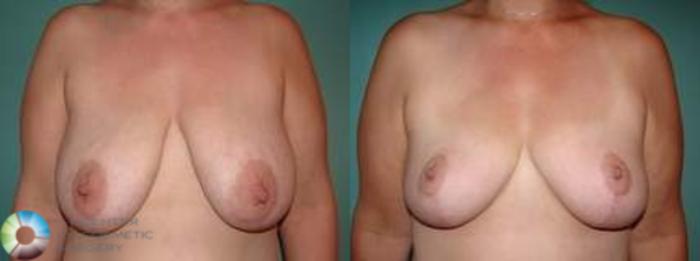 Before & After Breast Lift without Implants Case 543 Anterior in Denver and Colorado Springs, CO