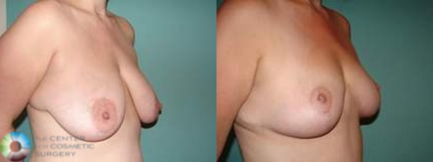 Denver Breast Lift Mastopexy
