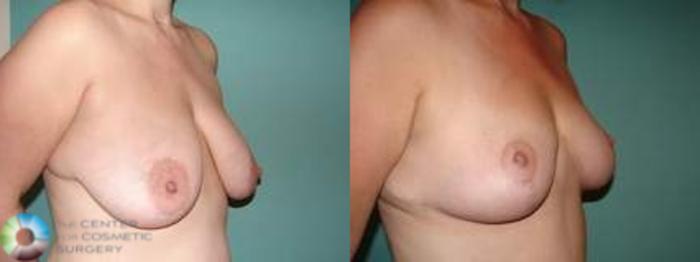 Before & After Breast Lift without Implants Case 543 Right Oblique in Denver and Colorado Springs, CO
