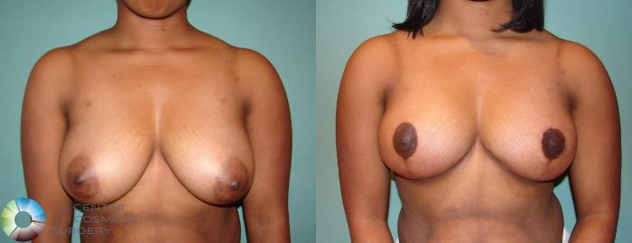 Before & After Breast Lift Case 544 View #1 in Denver, CO