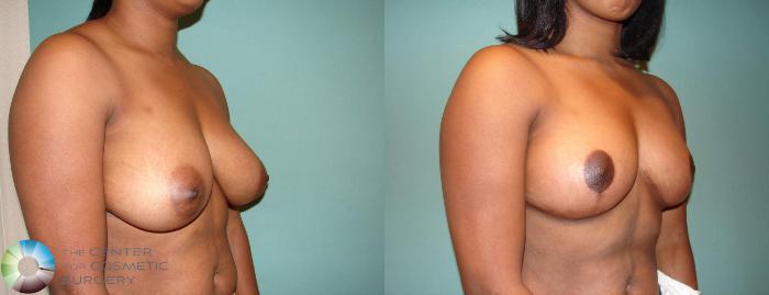 Before & After Breast Lift Case 544 View #2 in Denver, CO