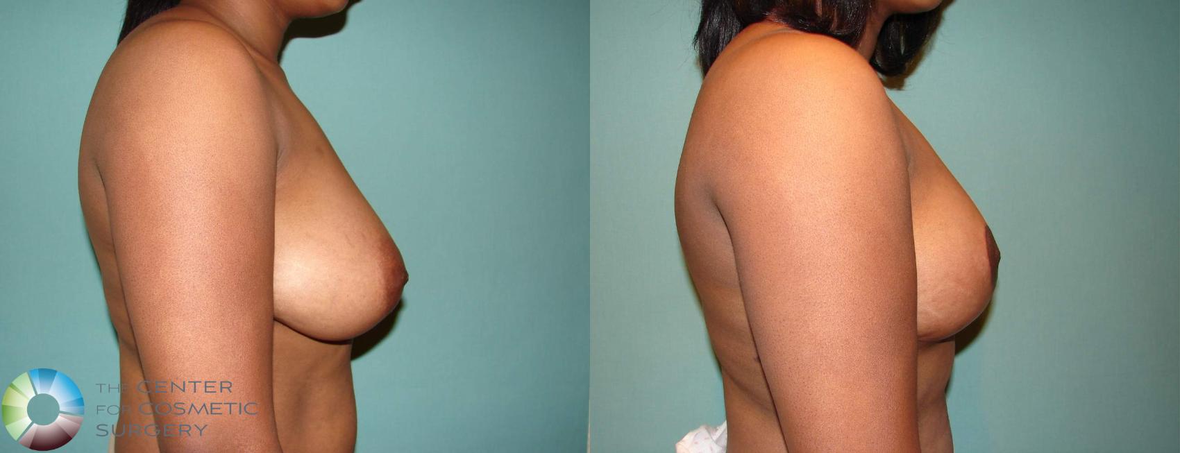 Before & After Breast Lift Case 544 View #3 View in Golden, CO