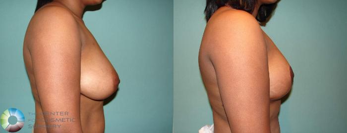 Before & After Breast Lift Case 544 View #3 in Denver, CO