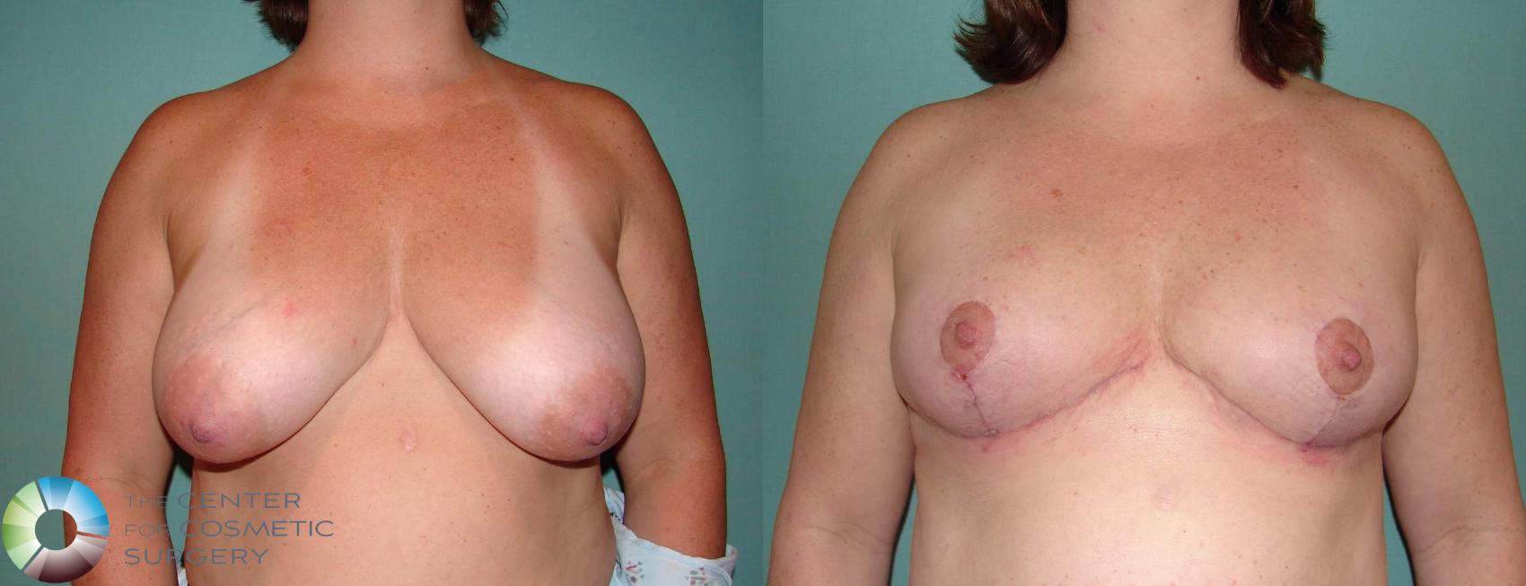 Before & After Breast Lift Case 587 View #1 View in Golden, CO