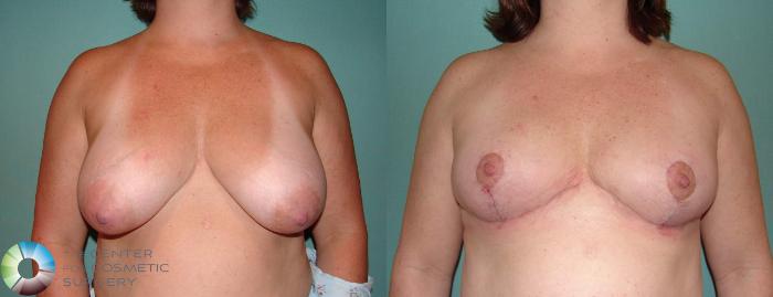 Before & After Breast Lift Case 587 View #1 in Denver and Colorado Springs, CO