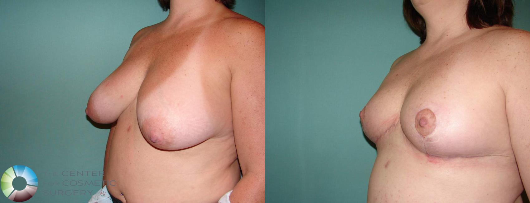 Before & After Breast Lift Case 587 View #2 View in Golden, CO
