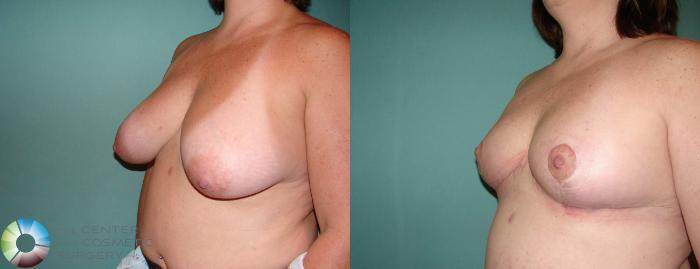 Before & After Breast Lift Case 587 View #2 in Denver and Colorado Springs, CO
