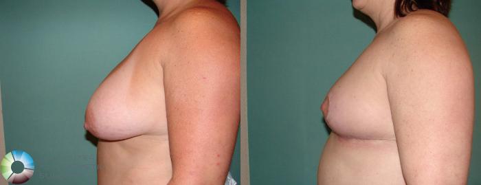 Before & After Breast Lift Case 587 View #3 in Denver and Colorado Springs, CO