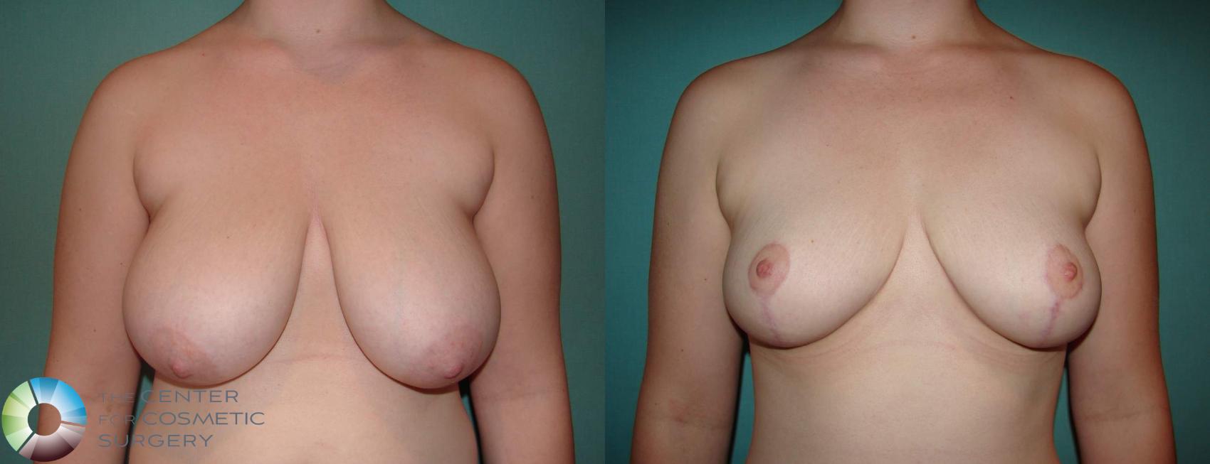 Before & After Breast Lift Case 588 View #1 in Denver and Colorado Springs, CO