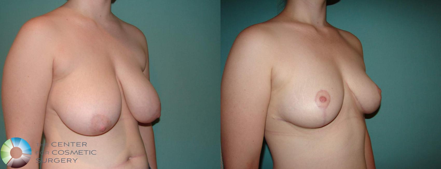 Before & After Breast Lift Case 588 View #2 in Denver and Colorado Springs, CO