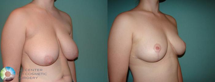 Before & After Breast Lift Case 588 View #2 View in Golden, CO