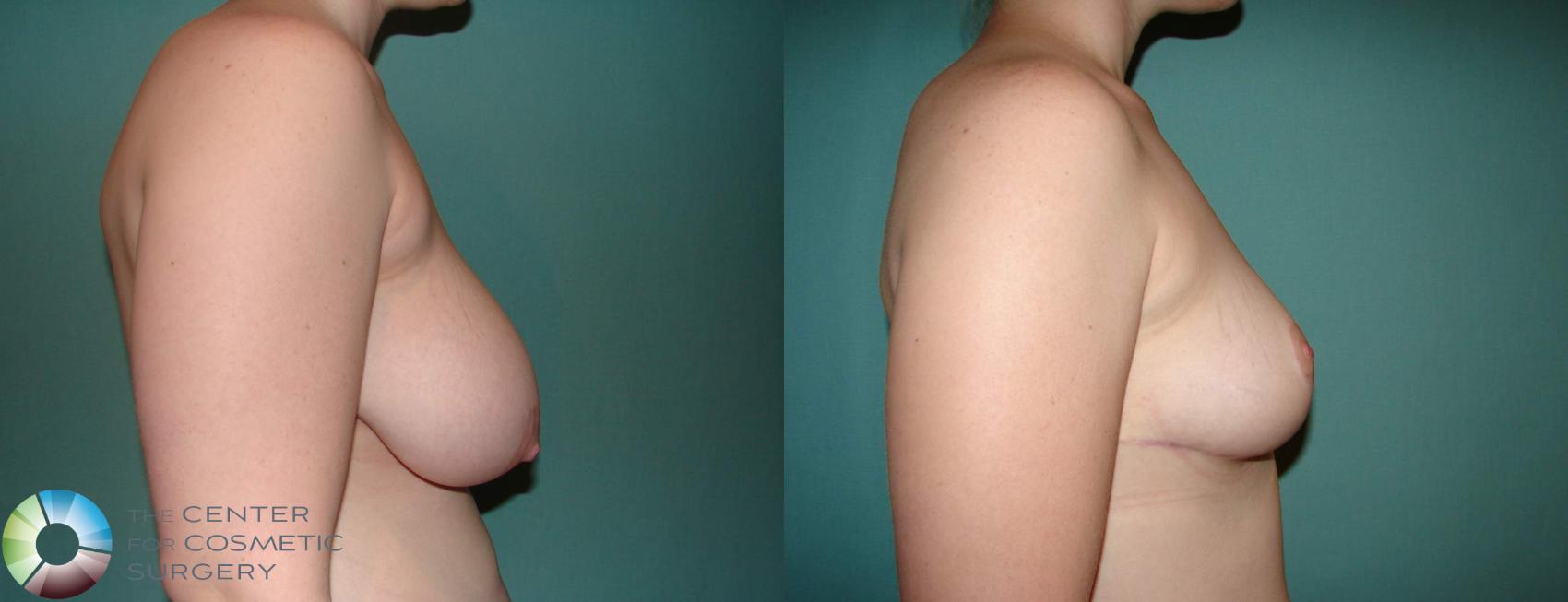 Before & After Breast Lift Case 588 View #3 in Denver and Colorado Springs, CO