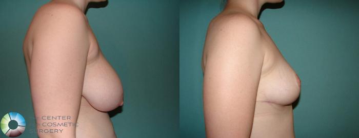 Before & After Breast Lift Case 588 View #3 View in Golden, CO
