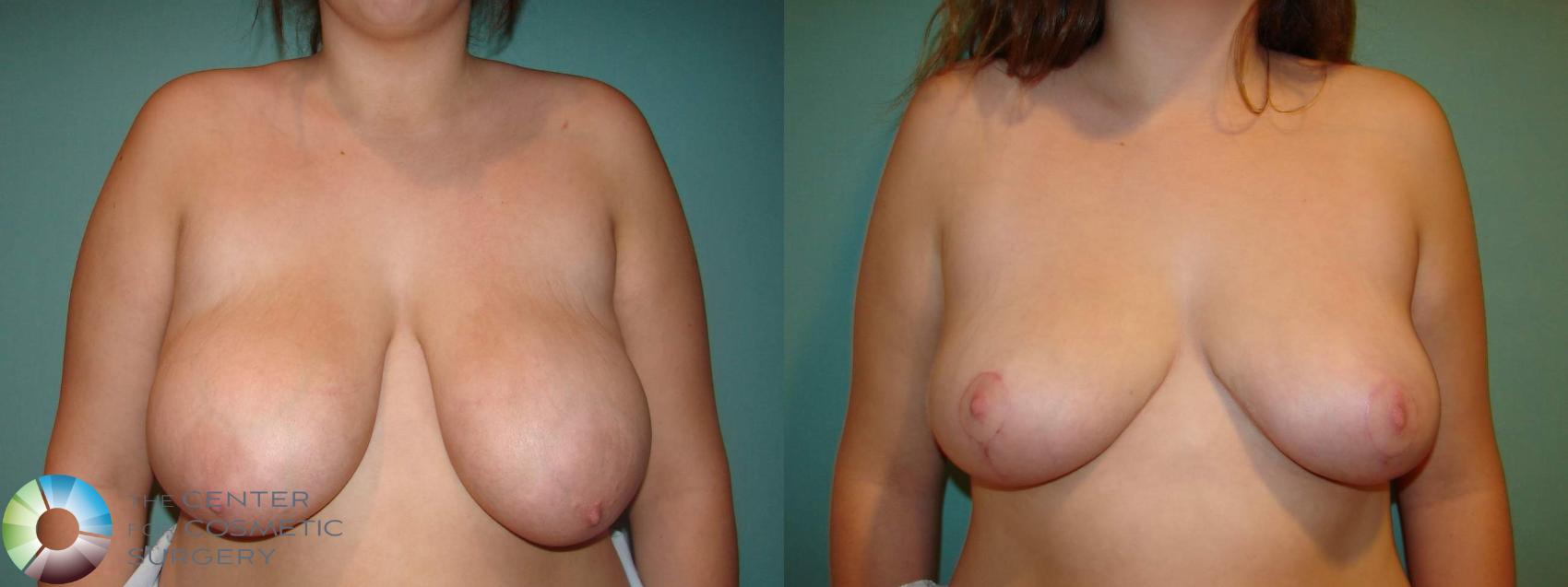 Denver Breast Lift Mastopexy