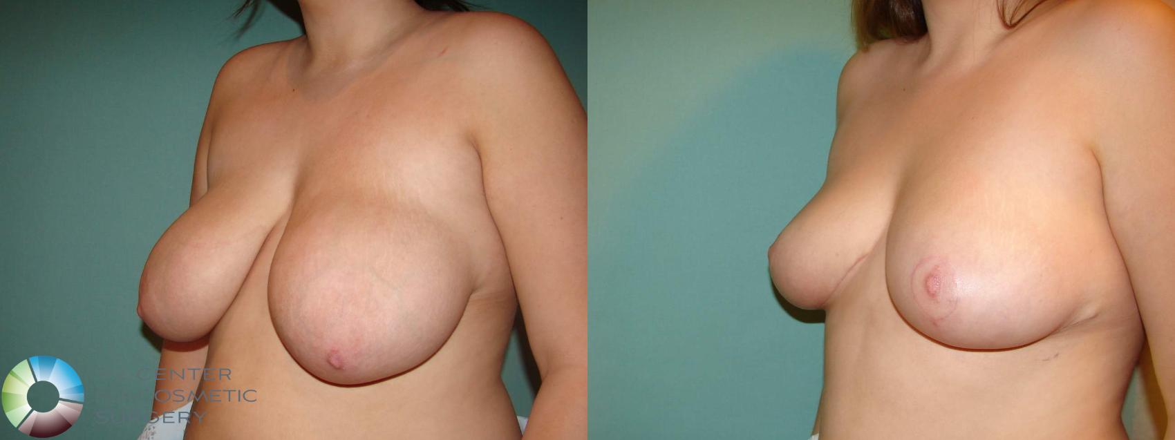 Denver Breast Lift Mastopexy
