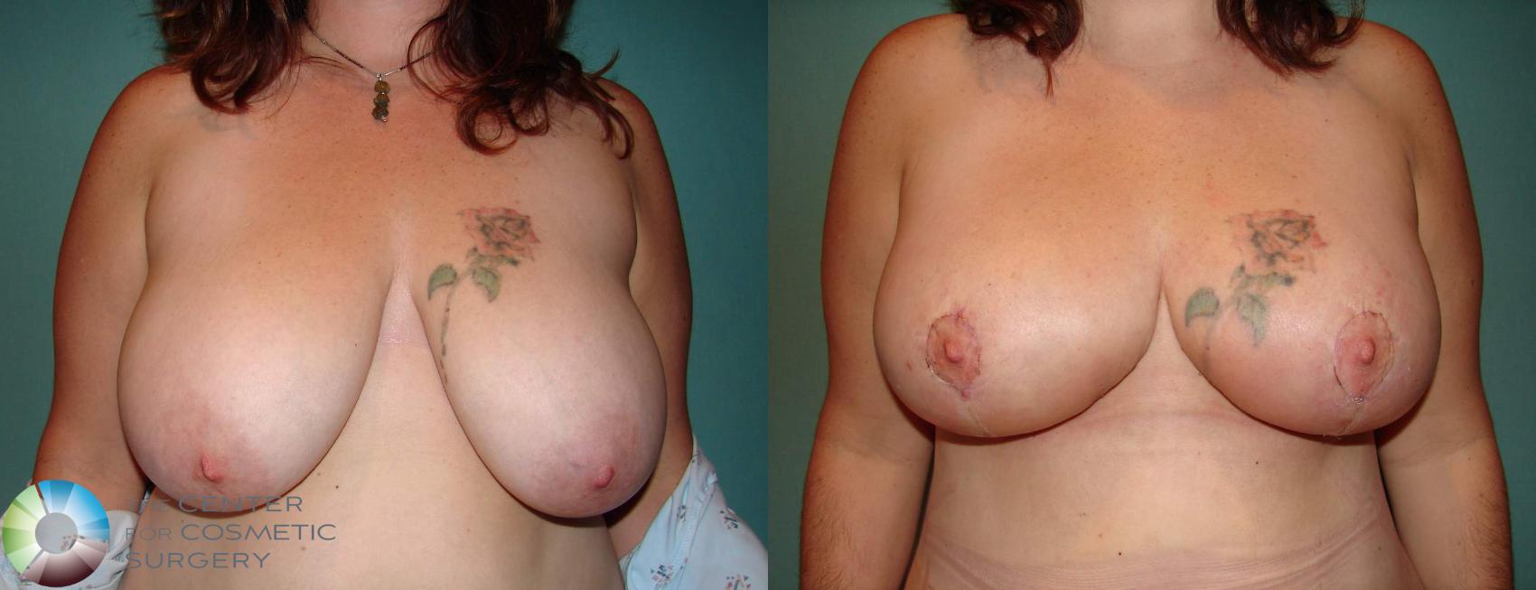 Before & After Breast Lift Case 593 View #1 View in Golden, CO