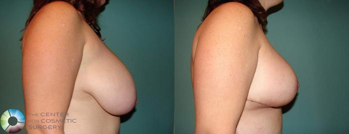 Before & After Breast Lift Case 593 View #3 View in Golden, CO