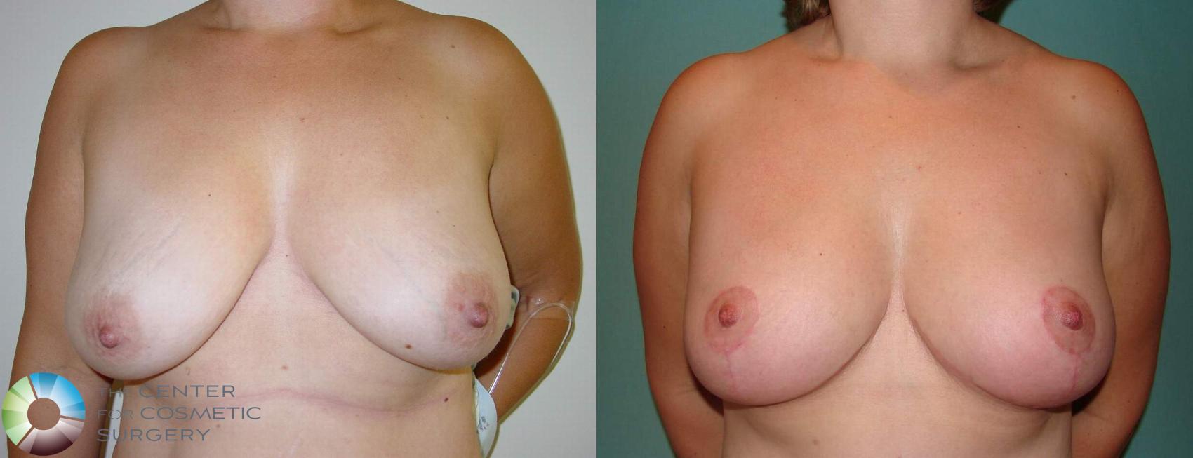 Before & After Breast Lift Case 595 View #1 View in Denver & Golden, CO