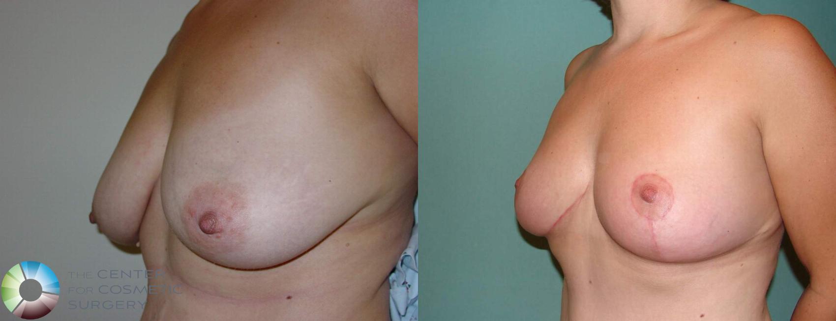 Before & After Breast Lift Case 595 View #2 in Denver and Colorado Springs, CO