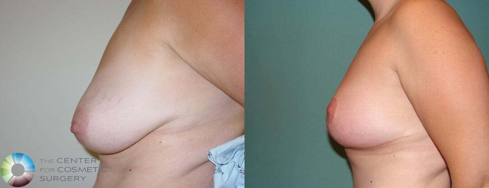 Before & After Breast Lift Case 595 View #3 in Denver and Colorado Springs, CO