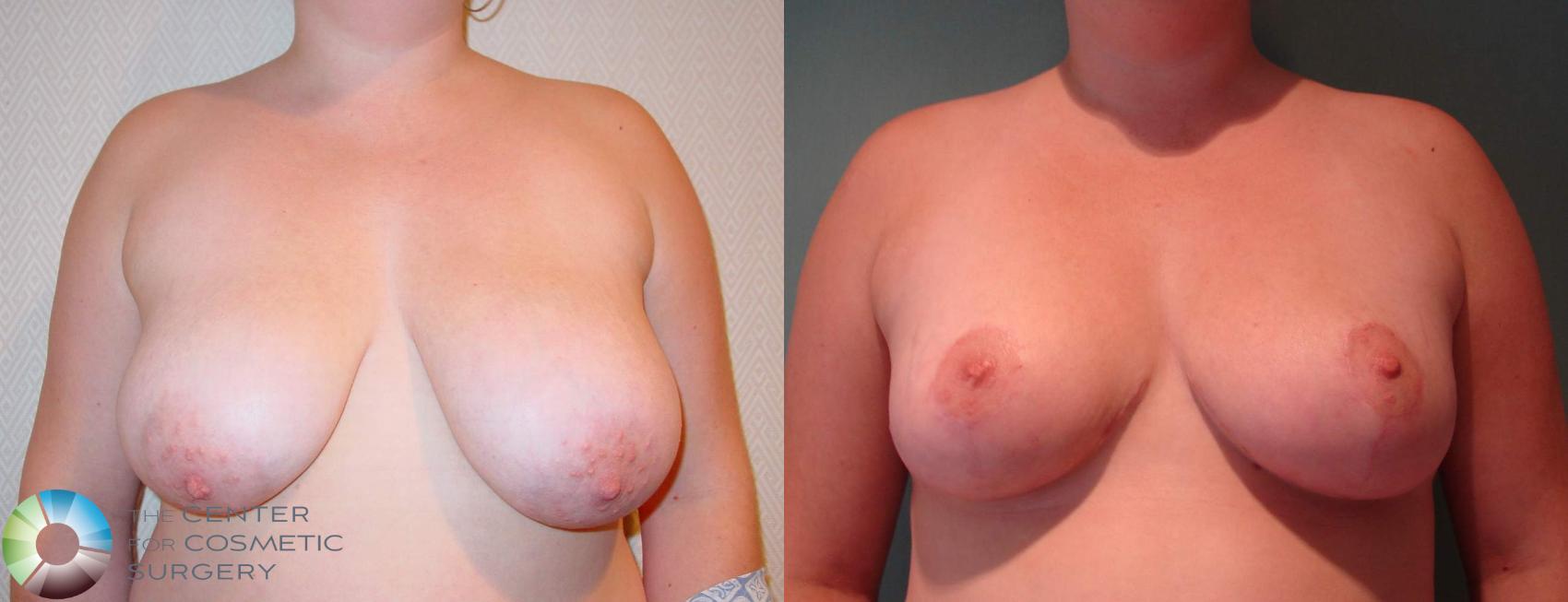 Before & After Breast Lift Case 596 View #1 in Denver and Colorado Springs, CO