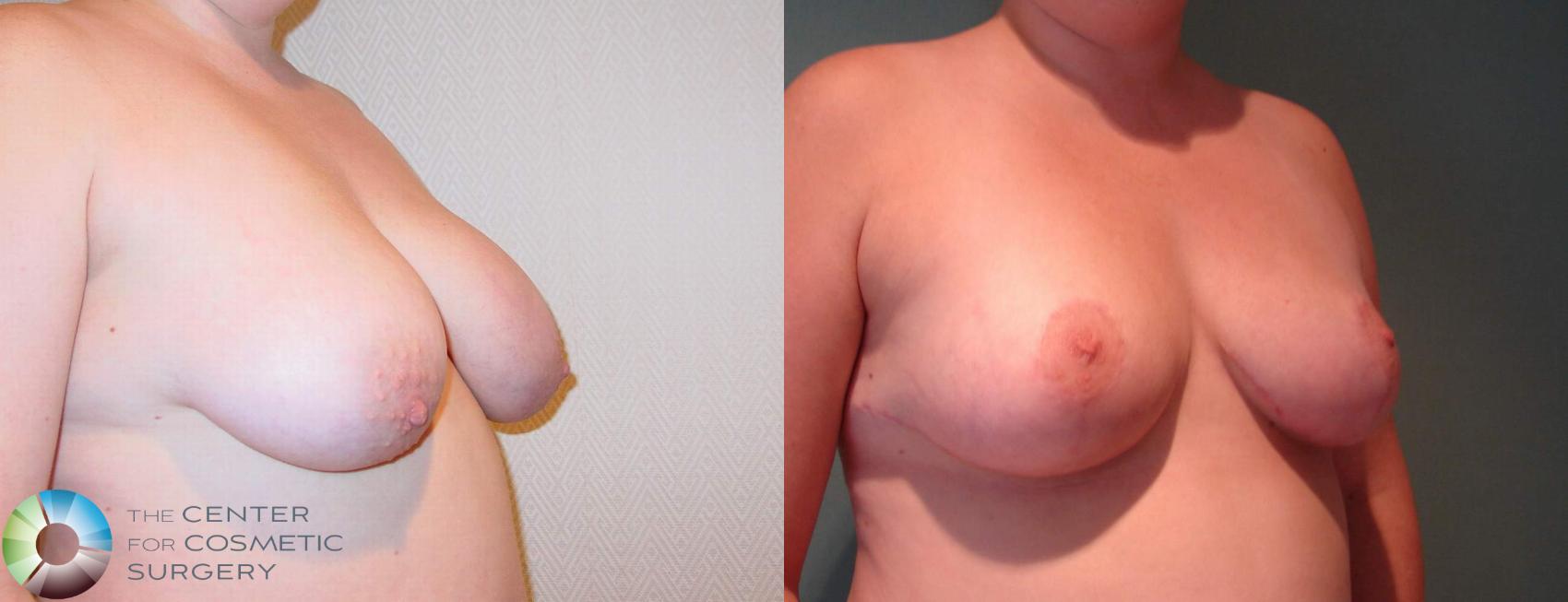 Before & After Breast Lift Case 596 View #2 in Denver and Colorado Springs, CO
