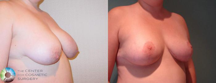 Before & After Breast Lift Case 596 View #2 View in Golden, CO