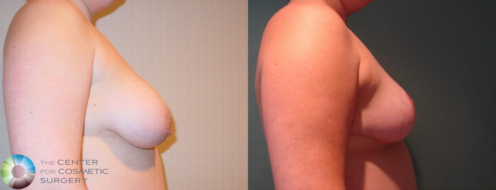 Before & After Breast Lift Case 596 View #3 in Denver and Colorado Springs, CO