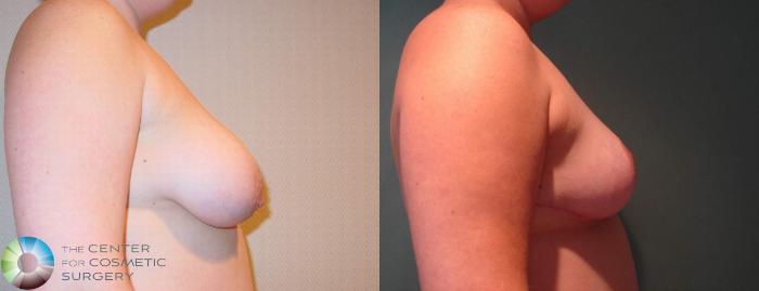 Before & After Breast Lift Case 596 View #3 View in Golden, CO
