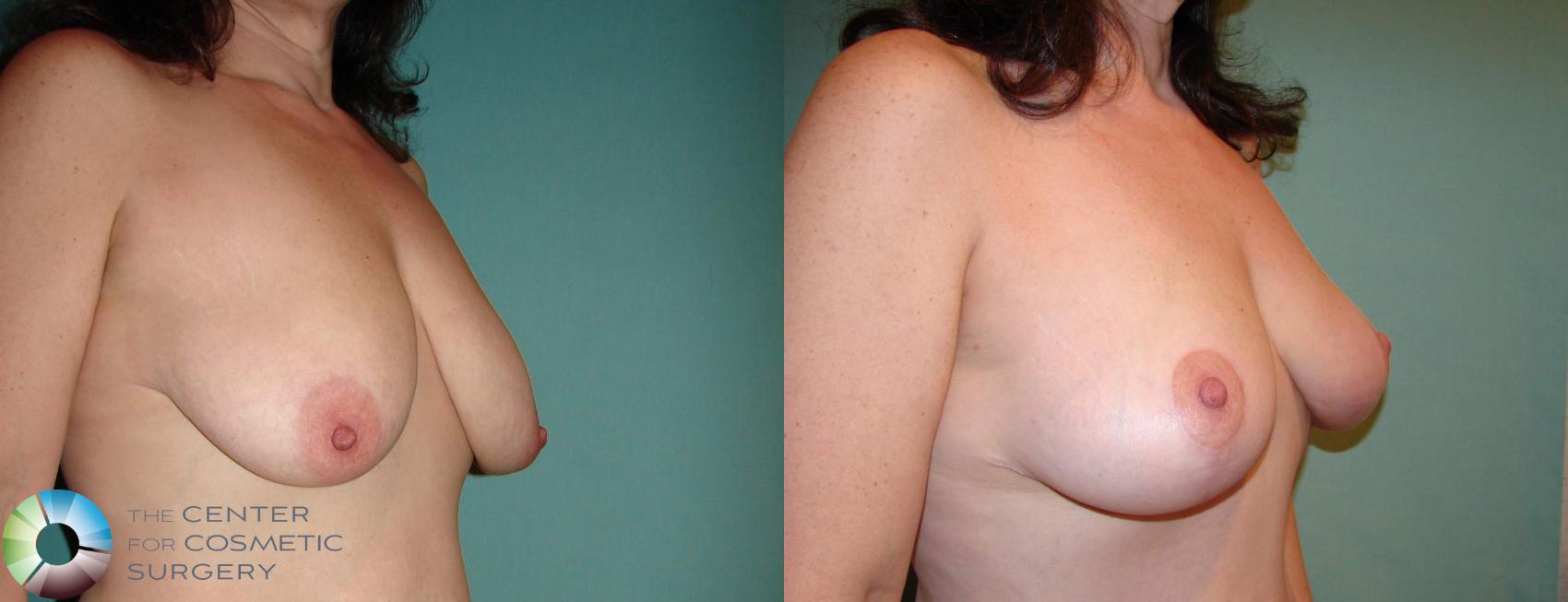 Before & After Breast Lift Case 597 View #1 View in Golden, CO