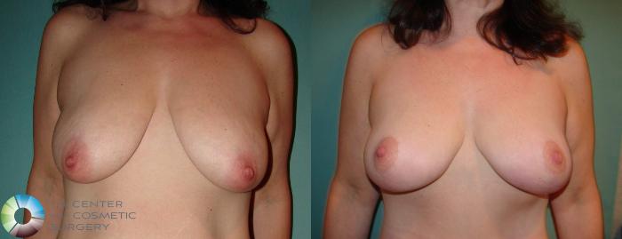 Before & After Breast Lift Case 597 View #3 View in Golden, CO