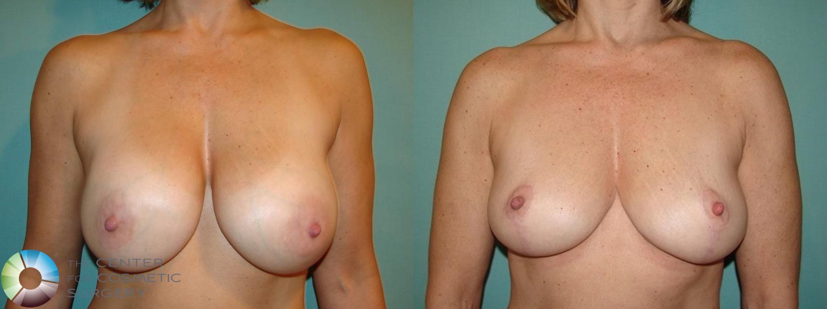 Before & After Breast Implant Revision Case 598 Anterior in Denver and Colorado Springs, CO