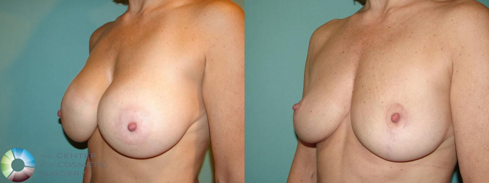 Best Denver Breast Implant Removal Mastopexy