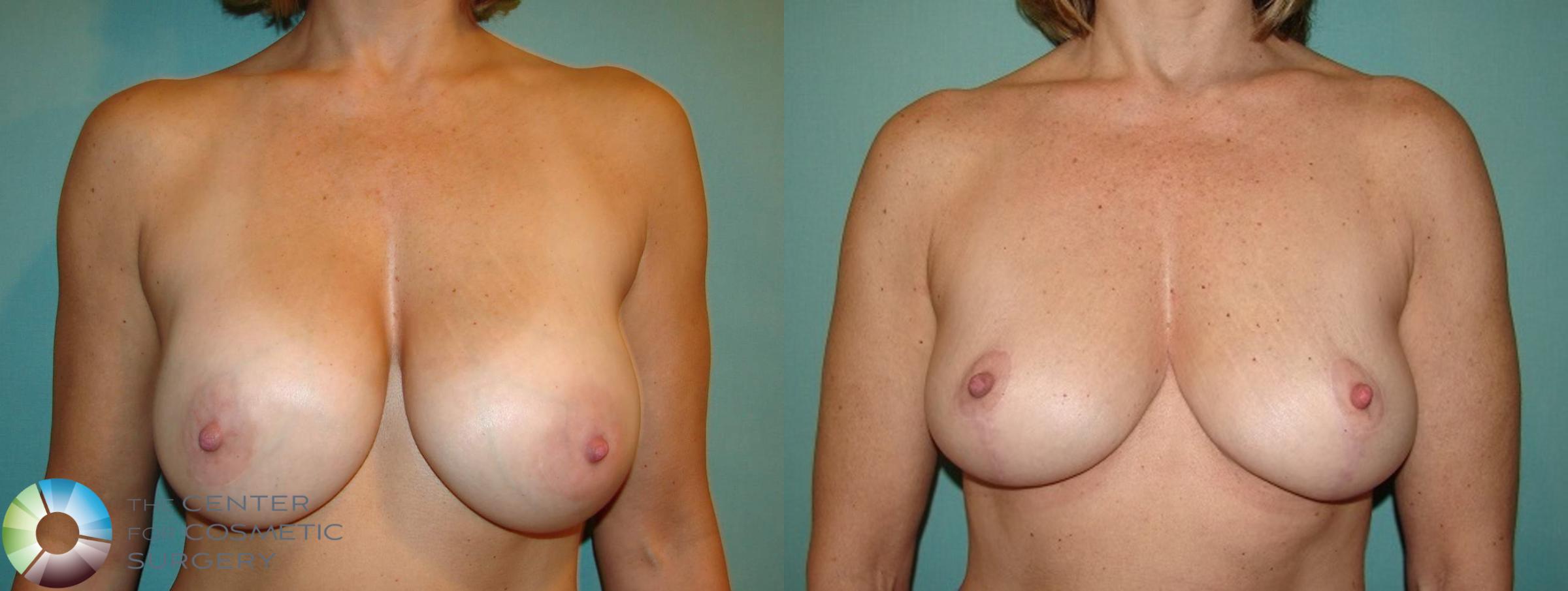 Breast Lift Case 598 Before & After View #1 | Golden, CO | The Center for Cosmetic Surgery