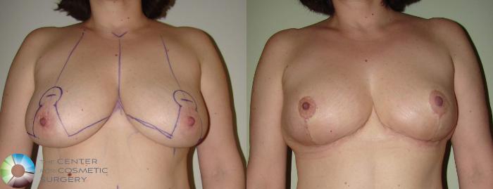 Before & After Breast Lift without Implants Case 623 View #1 in Denver and Colorado Springs, CO