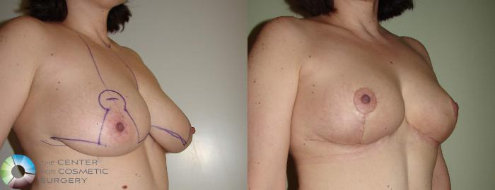 Before & After Breast Lift without Implants Case 623 View #2 in Denver and Colorado Springs, CO