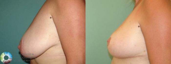 Best Denver Breast Lift Mastopexy