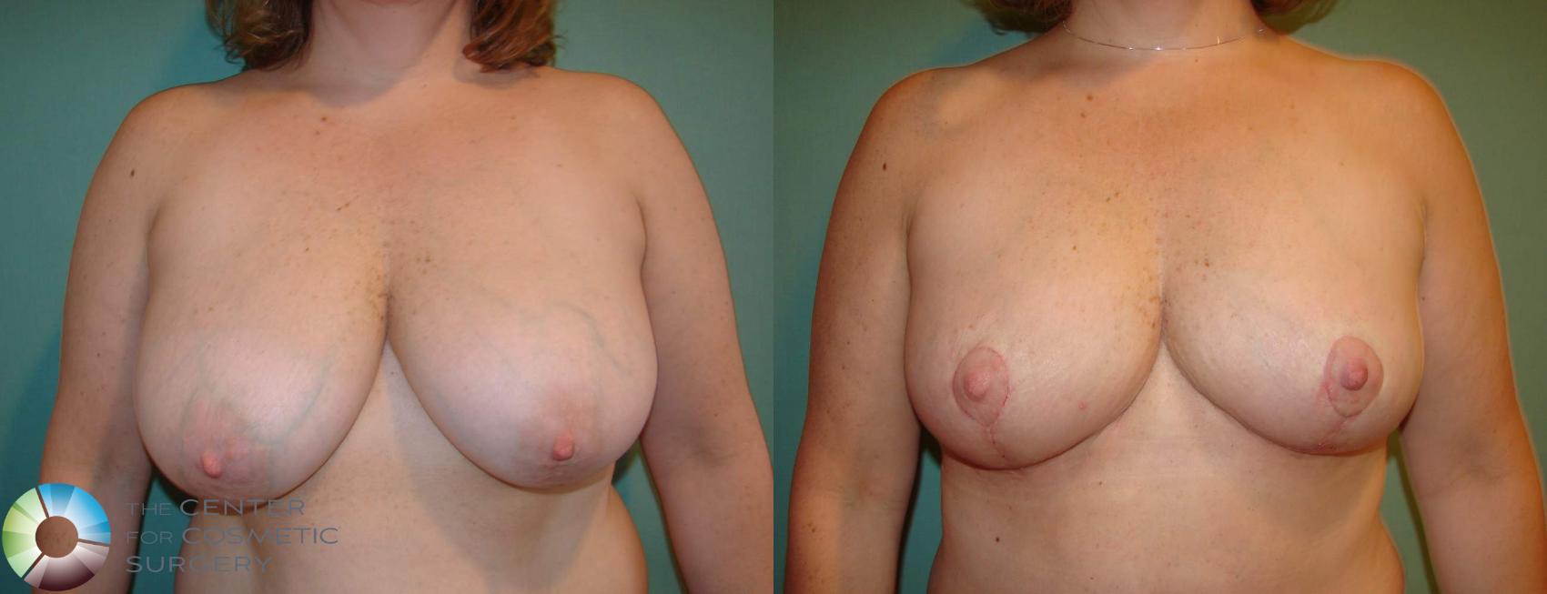 Before & After Breast Lift Case 640 View #1 View in Golden, CO