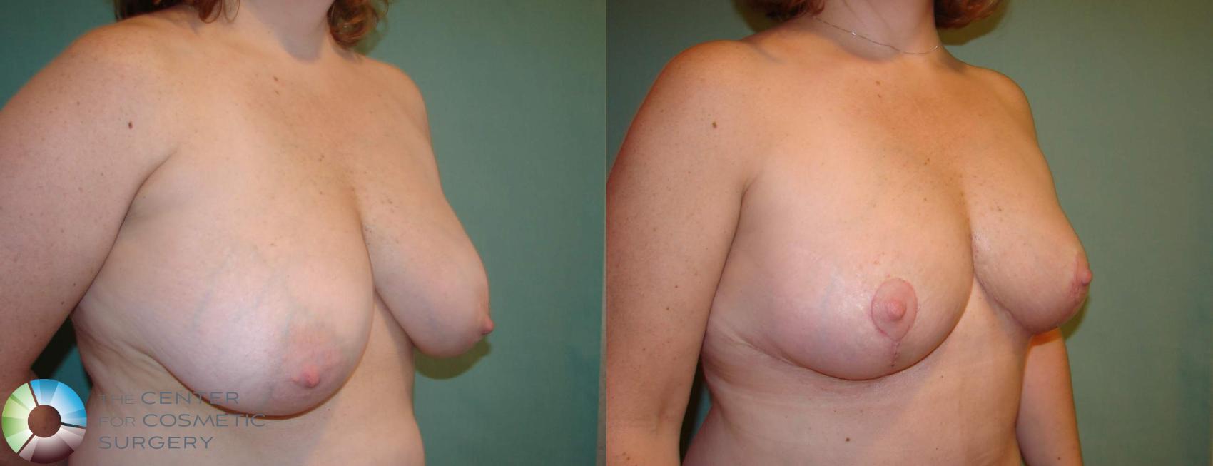 Before & After Breast Lift Case 640 View #2 in Denver and Colorado Springs, CO