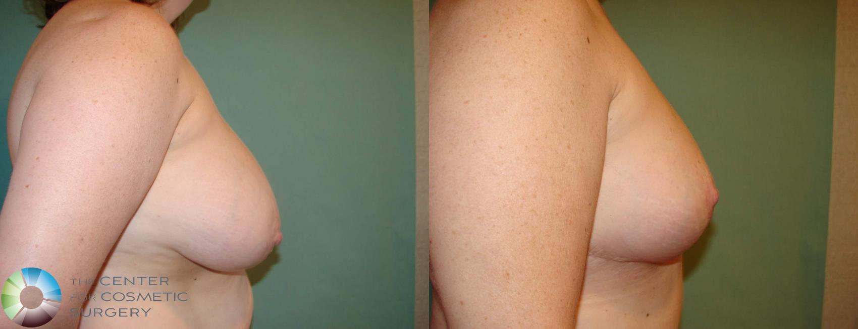 Before & After Breast Lift Case 640 View #3 in Denver and Colorado Springs, CO