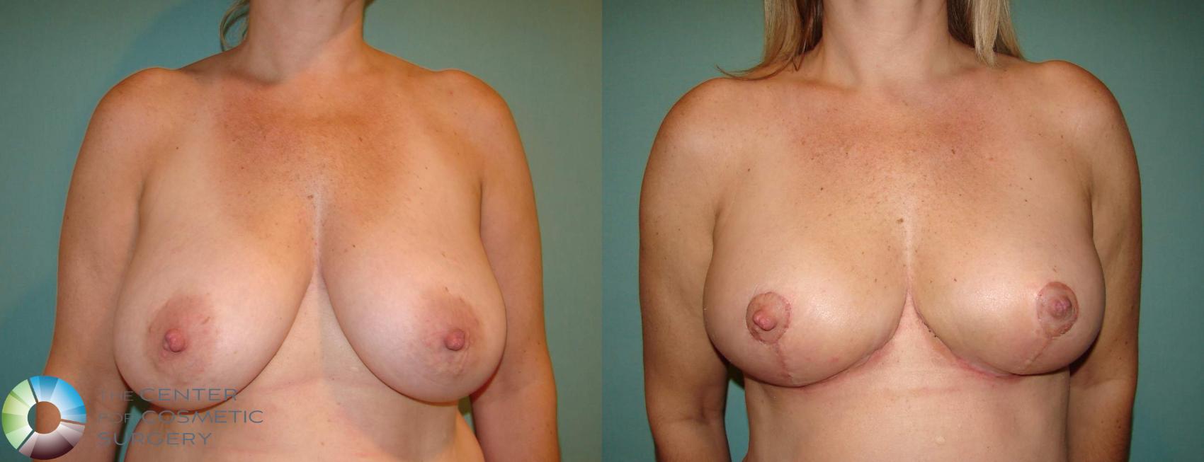 Before & After Breast Lift Case 648 View #1 in Denver and Colorado Springs, CO