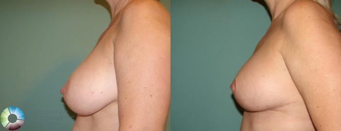 Before & After Breast Lift Case 648 View #3 View in Golden, CO