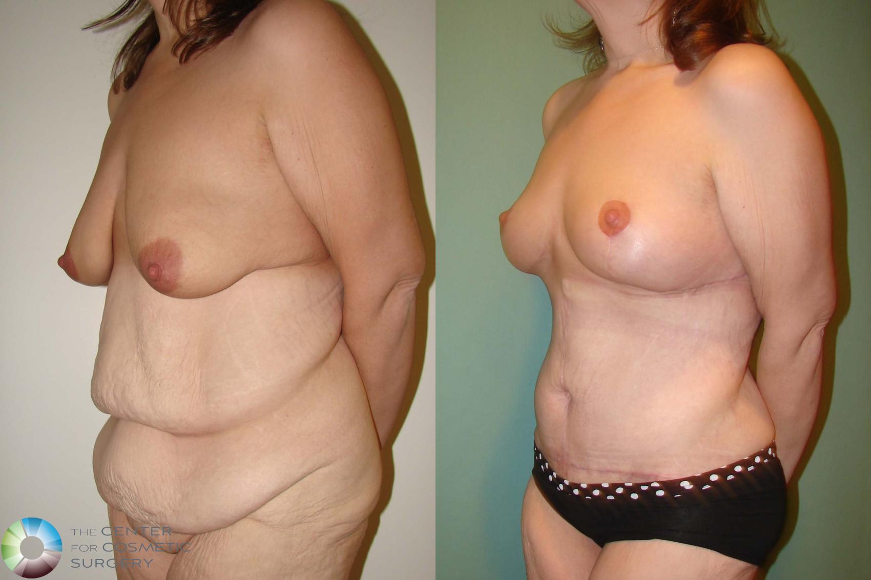 Before & After Breast Lift Case 664 View #2 View in Denver & Golden, CO
