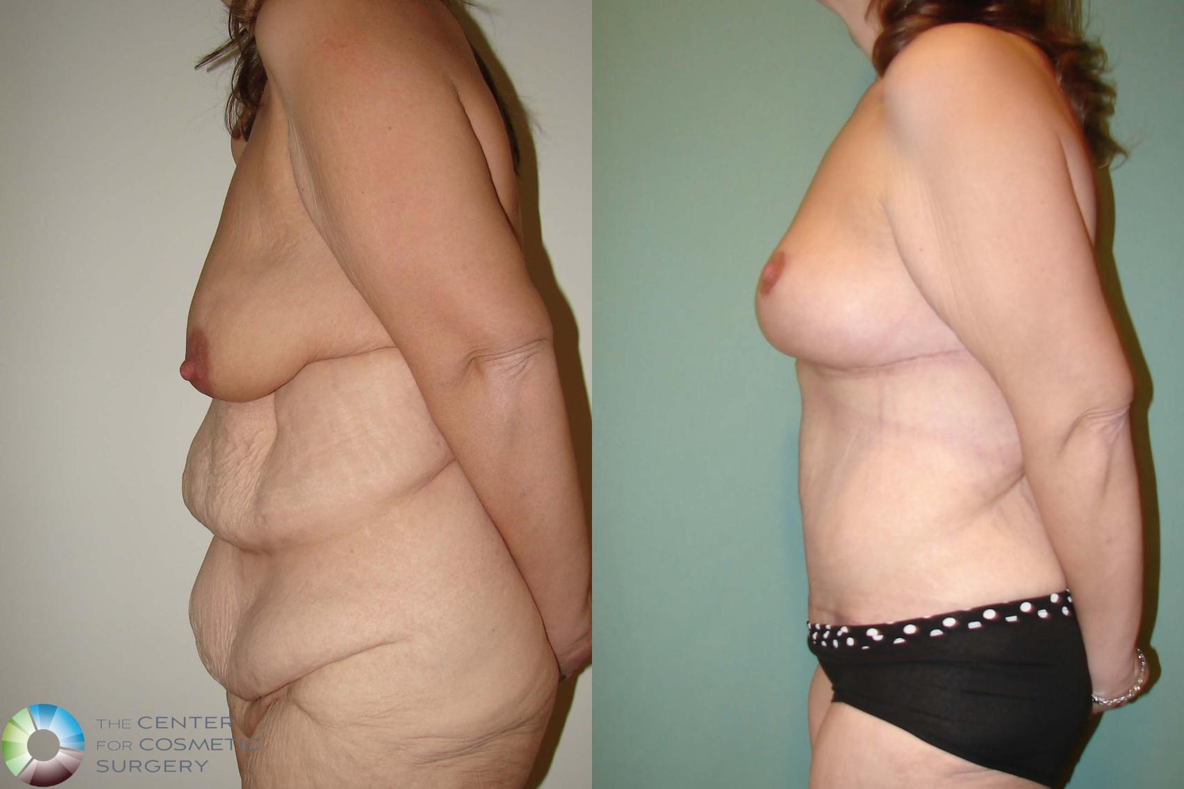 Before & After Breast Lift Case 664 View #3 View in Denver & Golden, CO