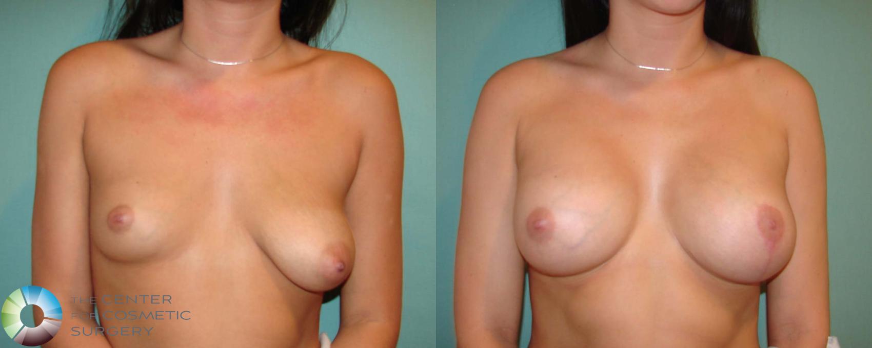 Before & After Breast Augmentation Case 666 View #1 View in Golden, CO