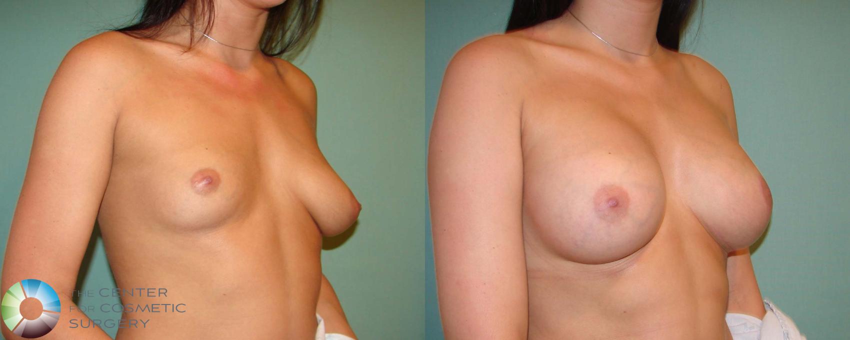 Before & After Breast Lift Case 666 View #2 in Denver and Colorado Springs, CO