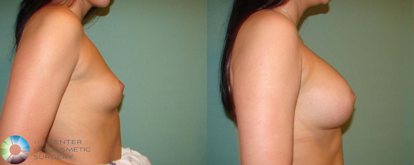 Before & After Breast Lift Case 666 View #3 in Denver and Colorado Springs, CO