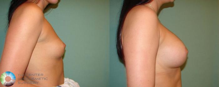 Before & After Breast Augmentation Case 666 View #3 View in Golden, CO
